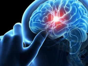 Tai biến mạch máu não là gì? Nguyên nhân và cách điều trị hiệu quả nhất