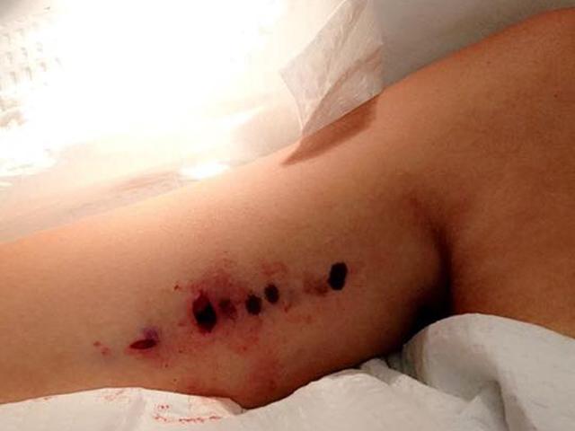 Mẹ hốt hoảng vì que cấy tránh thai bỗng biến mất, bác sĩ đục 5 lỗ tìm cũng không thấy