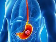 Sức khỏe - Triệu chứng ung thư dạ dày là gì? Nguyên nhân và cách điều trị