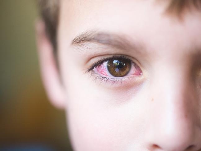 Đau mắt đỏ kiêng ăn gì? Dấu hiệu và cách chữa hiệu quả nhất - 1