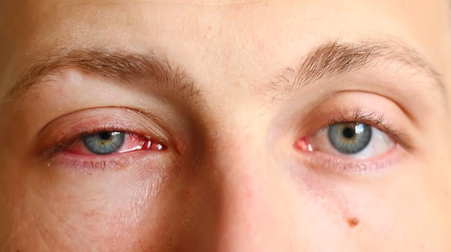 Đau mắt đỏ kiêng ăn gì? Dấu hiệu và cách chữa hiệu quả nhất - 2