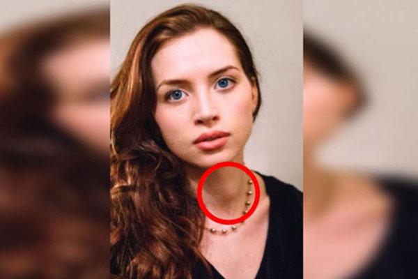 Bức ảnh tố dấu hiệu ung thư tuyến giáp từ 1 năm trước nhưng cô gái không nhận ra - 3