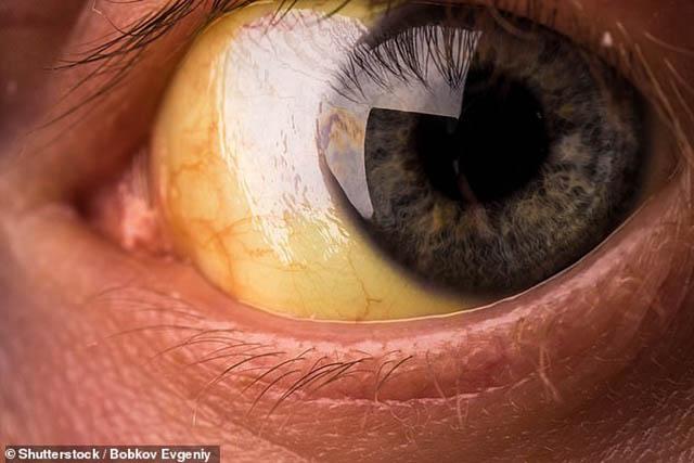 tuong la dau hieu binh thuong cua co the, hoa ra lai la benh rat nguy hiem - 6