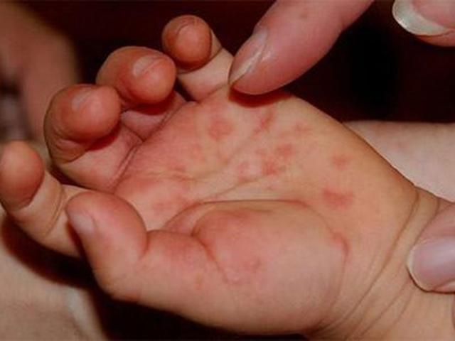 Chủng virus gây đại dịch tay chân miệng năm 2011 đã trở lại, cha mẹ nhất định phải biết