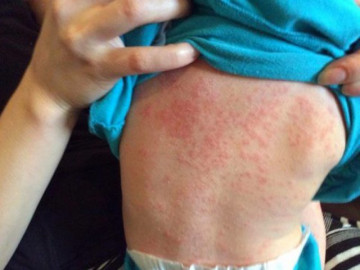 Bệnh sởi tấn công cả trẻ nhỏ và người lớn trong mùa hè: Những biểu hiện cần nhập viện ngay