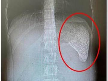 Lá lách của cô gái 28 tuổi như viên gạch rỗ, bác sĩ hãi hùng khi biết lý do