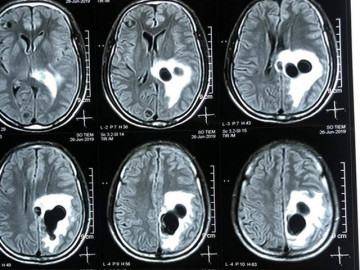 Liệt nửa người, não có 5 tổ sán do món khoái khẩu tiết canh