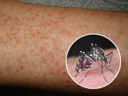 Sức khỏe - Sốt xuất huyết nên ăn gì để bệnh nhanh khỏi, tránh biến chứng?