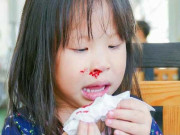 Sức khỏe - Trẻ nhập viện vì chảy máu cam ngày nóng, cảnh báo điều cha mẹ cần làm để không hại con