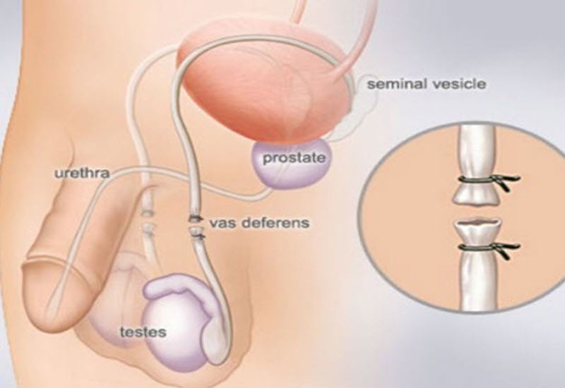 Thắt ống dẫn tinh cũng là một loại phẫu thuật. Nói chung, đàn ông nên chú ý vệ sinh cá nhân sau khi thắt.
