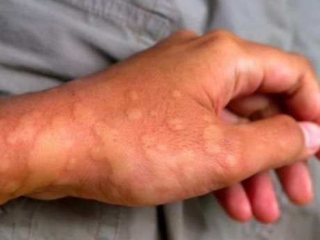 Nguyên nhân nổi mề đay không phải ai cũng biết