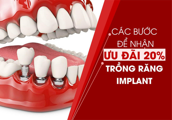 Các bước để nhận ưu đãi 20% trồng răng Implant - 1