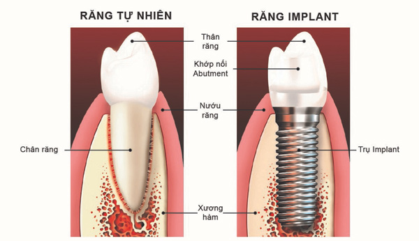 Các bước để nhận ưu đãi 20% trồng răng Implant - 2