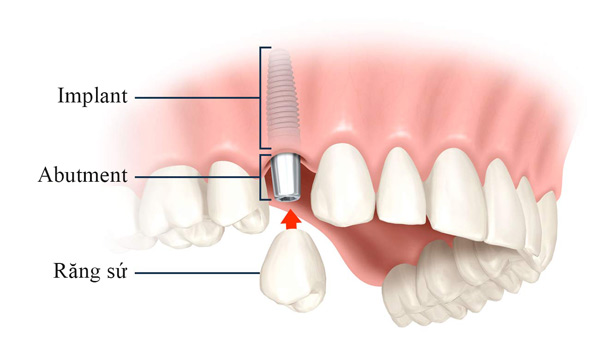 Các bước để nhận ưu đãi 20% trồng răng Implant - 3