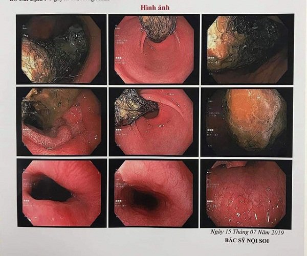 Thấy con mất từng mảng tóc, lại kêu đau bụng, đi khám người mẹ ngỡ ngàng khi biết sự thật - 1