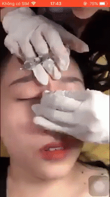soc truoc canh tiem filler mui tho bao, chi em bao gio moi thoi tin vao tham my gia re? - 3