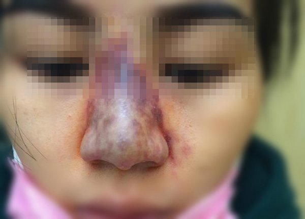 soc truoc canh tiem filler mui tho bao, chi em bao gio moi thoi tin vao tham my gia re? - 11
