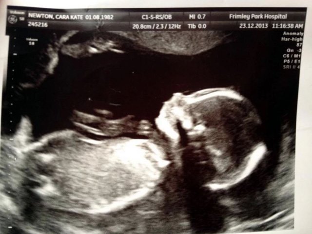 Đau đớn nhận tin vô sinh sau điều trị ung thư xương, 3 năm sau mẹ nhận tin bất ngờ