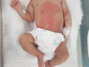 Sức khỏe - Mẹ chữa chướng bụng theo cách không ít người làm, bé 14 ngày tuổi nhập viện vì bị bỏng nặng