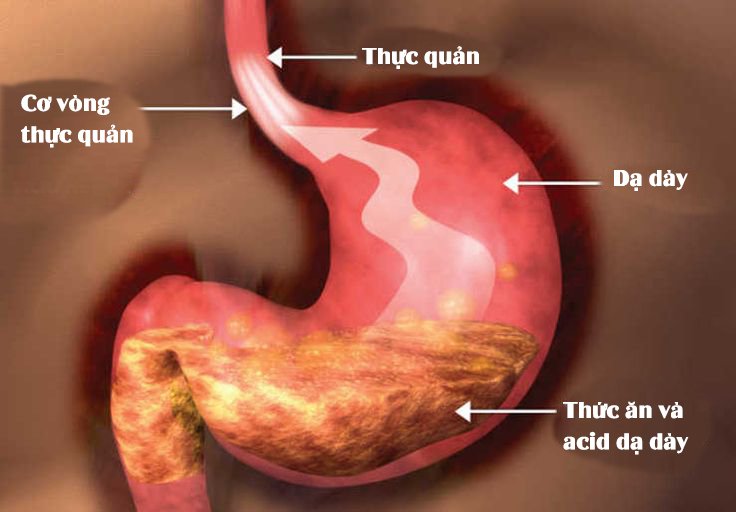 9 loại thảo dược làm giảm axit dạ dày - Giải pháp tự nhiên hiệu quả cho sức khỏe tiêu hóa 9 loại thảo dược làm giảm axit dạ dày - Giải pháp tự nhiên hiệu quả cho sức khỏe tiêu hóa