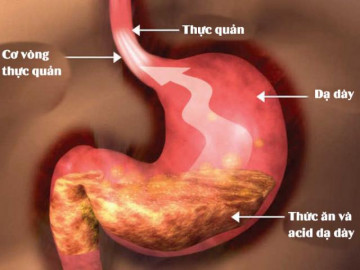 Trào ngược dạ dày nên ăn gì?