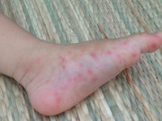 Sức khỏe - Nhà có trẻ nhỏ, có nên tự phun thuốc diệt muỗi để phòng ngừa sốt xuất huyết?