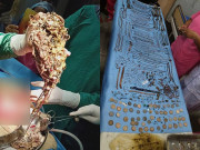 Tin tức - Con gái liên tục nôn ói sau ăn, mẹ tá hỏa phát hiện thứ đáng giá 1,5 tỷ trong bụng