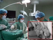 Bà bầu - Mẹ Cần Thơ vào viện cấp cứu, bé chào đời dây rốn dài gần 1m, quấn cả cổ cả chân