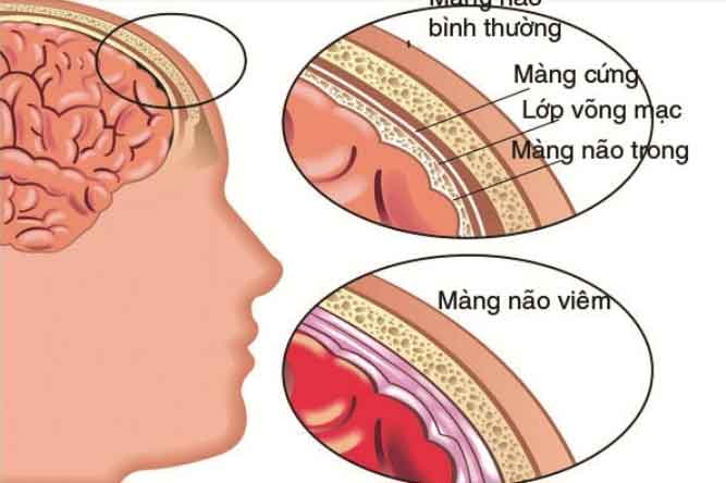 viem mang nao nhiem khuan o tre em: bs chi ro ba dau hieu vang de cuu tre - 4