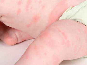 Trẻ bị dị ứng nổi mẩn đỏ, phát ban do đâu và cách xử lý