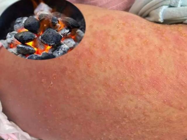 Bé sơ sinh viêm da mưng mủ khắp lưng vì sai lầm của bà nội