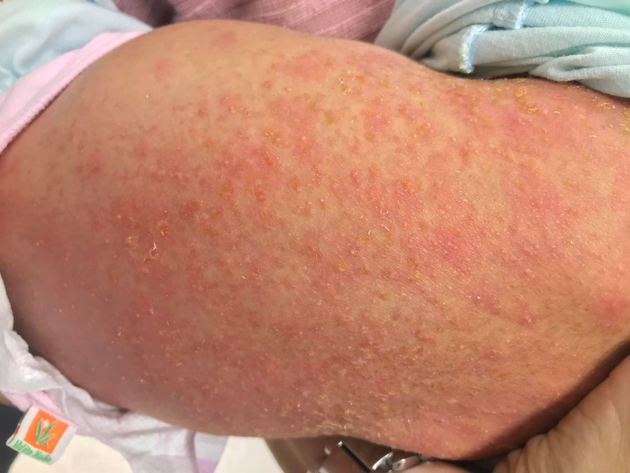 Bé sơ sinh viêm da mưng mủ khắp lưng vì sai lầm của bà nội - 1