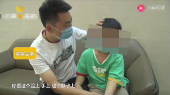 Cậu bé 8 tuổi mắc bệnh bạch biến vì thường quên làm điều này mỗi buổi sáng - 1