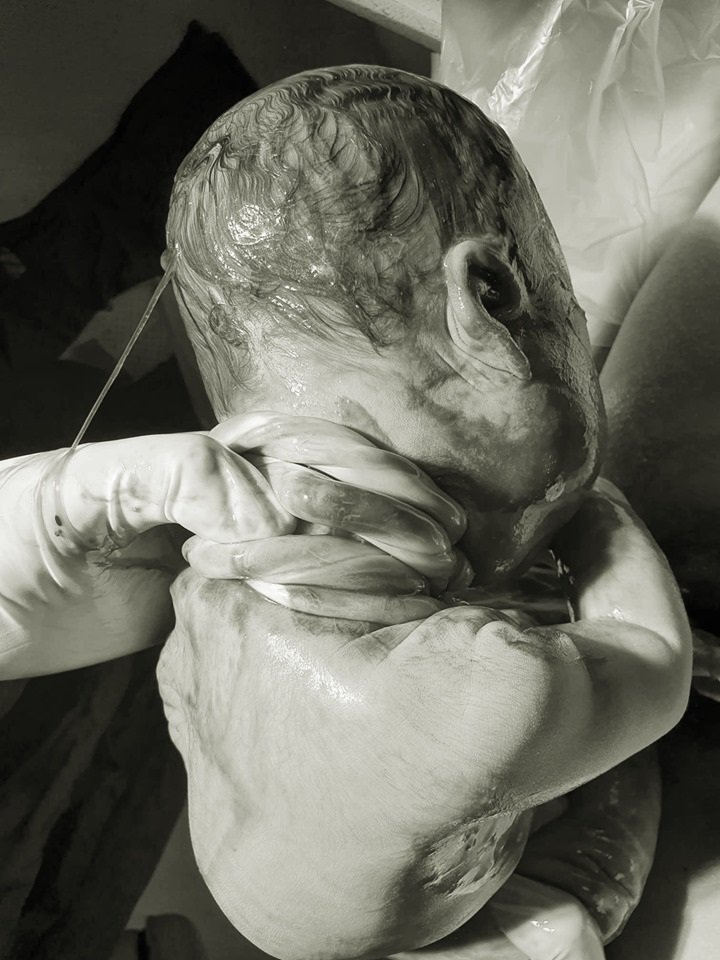 Em bé Việt sinh thường với 4 vòng dây rốn quấn cổ khiến các mẹ xôn xao - 1