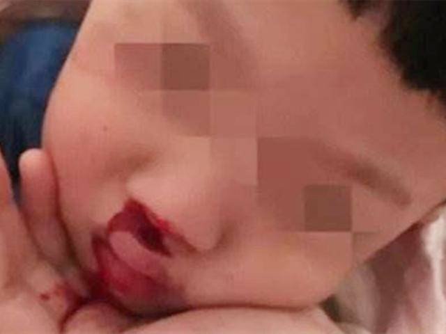 Bé 3 tuổi mất mạng vì cách sơ cứu chảy máu cam phổ biến của nhiều bà mẹ