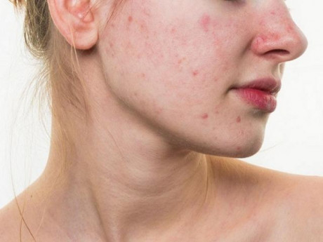 Dị ứng da mặt phải xử lý thế nào?