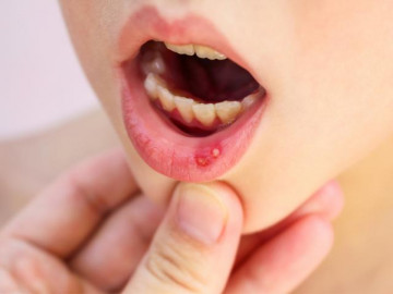Cách trị lở miệng không cần dùng thuốc