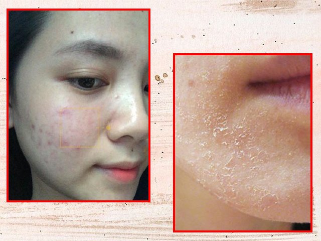 Nếu da mặt có những dấu hiệu dưới đây, bạn cần thay đổi quy trình skincare ngay lập tức