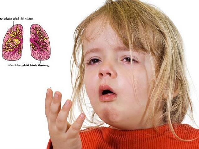 Viêm phổi ở trẻ em và những điều cần lưu ý