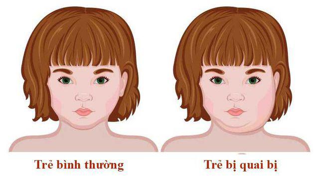 Trẻ bị quai bị: Bác sĩ chỉ rõ dấu hiệu nhận biết và cách phòng ngừa hiệu quả - 4