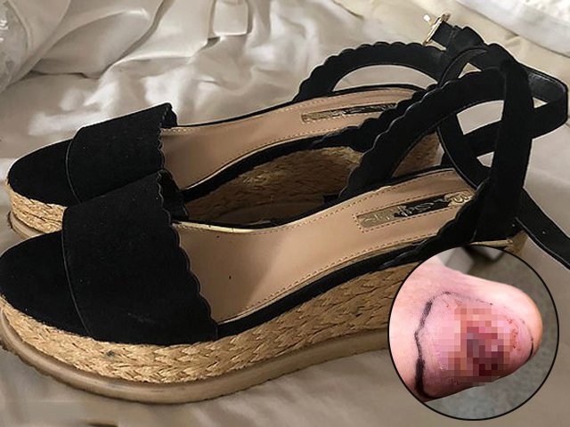 Bị thương khi đi giày có quai hậu, nữ người mẫu xinh đẹp suýt phải cắt chân