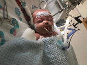 Sức khỏe - Bé trai 11 tháng tuổi "rụng" toàn bộ tay chân chỉ sau 2 ngày bị viêm họng