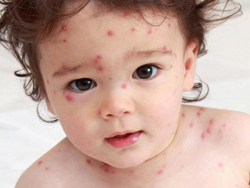 Thủy đậu ở trẻ em: Triệu chứng, lây lan, cách chăm sóc không bị biến chứng