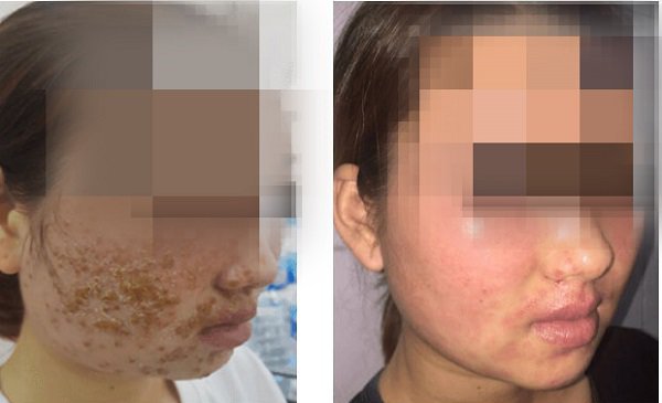 Ngứa cào rách mặt vẫn chủ quan nghĩ là dị ứng, cô gái trẻ bất ngờ khi biết nguyên nhân - 1