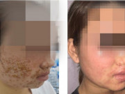 Sức khỏe - Ngứa cào rách mặt vẫn chủ quan nghĩ là dị ứng, cô gái trẻ bất ngờ khi biết nguyên nhân