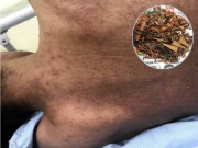 Sức khỏe - Người đàn ông bị ngộ độc thạch tín, suýt chết vì thói quen xông nhà lấy may gần 10 năm