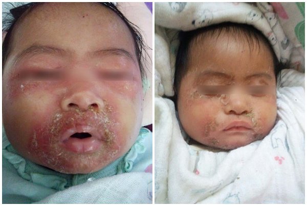 Con gái 5 tháng tuổi bị nhiễm trùng da nghiêm trọng, người mẹ bất ngờ khi biết nguyên nhân - 2