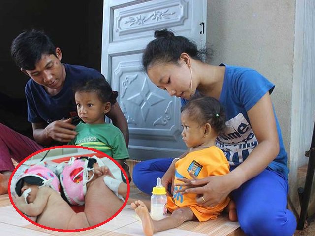 Cuộc sống của 3 cặp song sinh dính liền mông, không hậu môn giờ ra sao?