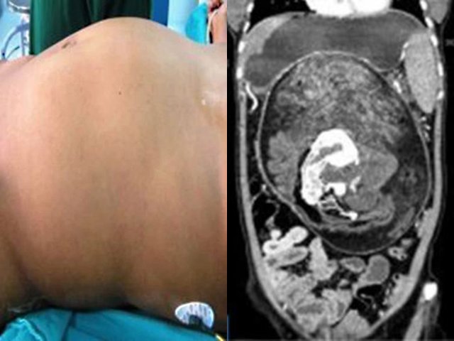 Con gái 17 tuổi bụng ngày một lớn dần, kết quả siêu âm khiến cả nhà ngã ngửa