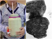 Sức khỏe - Thường xuyên bỏ cơm, uống trà sữa, chàng trai trẻ bị tắc ruột nhập viện cấp cứu